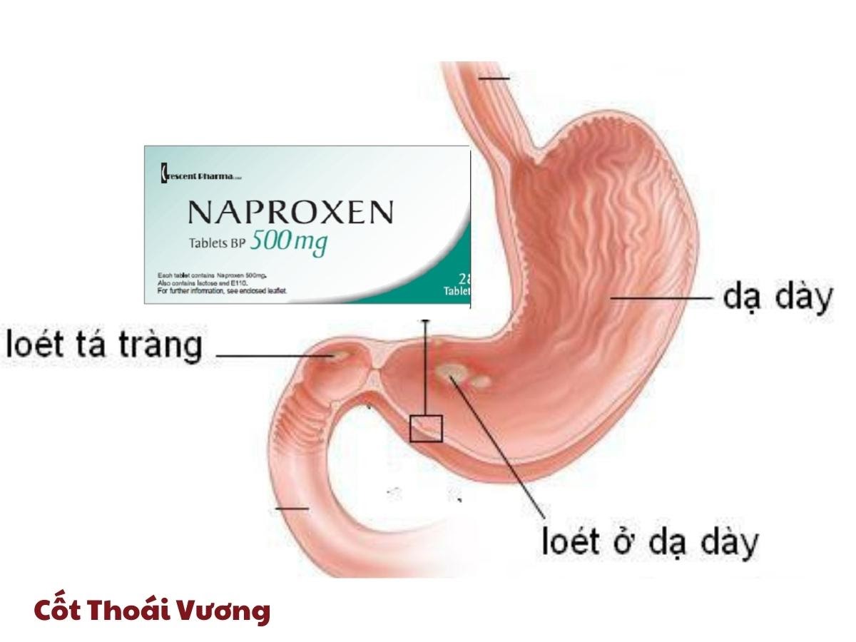 Loét dạ dày tá tràng là tác dụng phụ phổ biến nhất của Naproxen